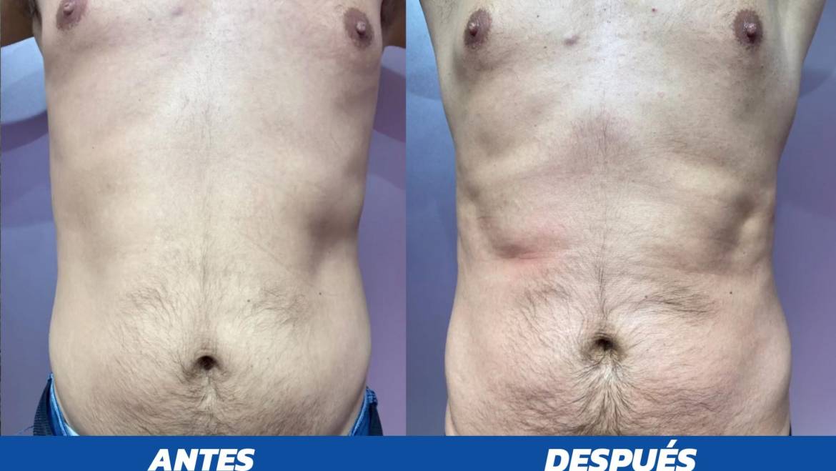 Qué es y resultados con el uso de PROSCULPT – HIEMT o tecnología electromagnética de alta intensidad en el área estética.