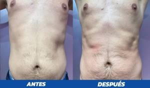 antes y despues PROSCULPT