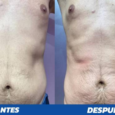 Qué es y resultados con el uso de PROSCULPT – HIEMT o tecnología electromagnética de alta intensidad en el área estética.